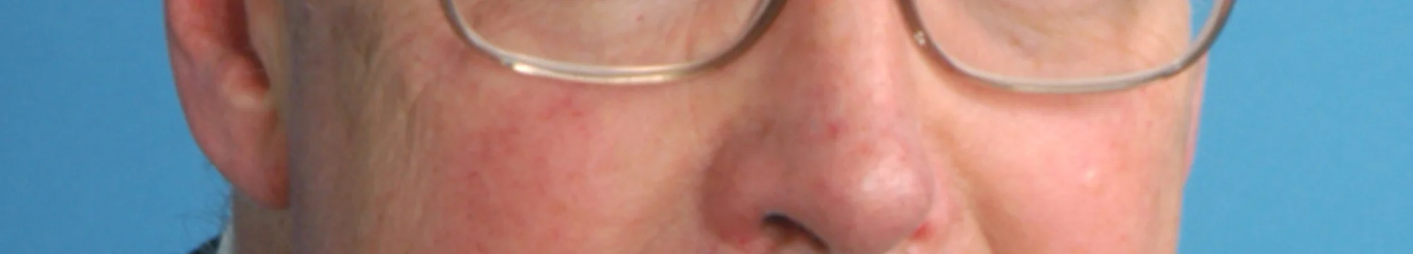 Schläfenarterienentzündung mit Erblindung: Berichte über Zeichen einer Arteriitis temporalis im 18. Jahrhundert*