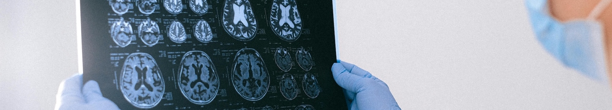 Role of ZBTB18 Tumor Suppression in Glioblastoma Progression