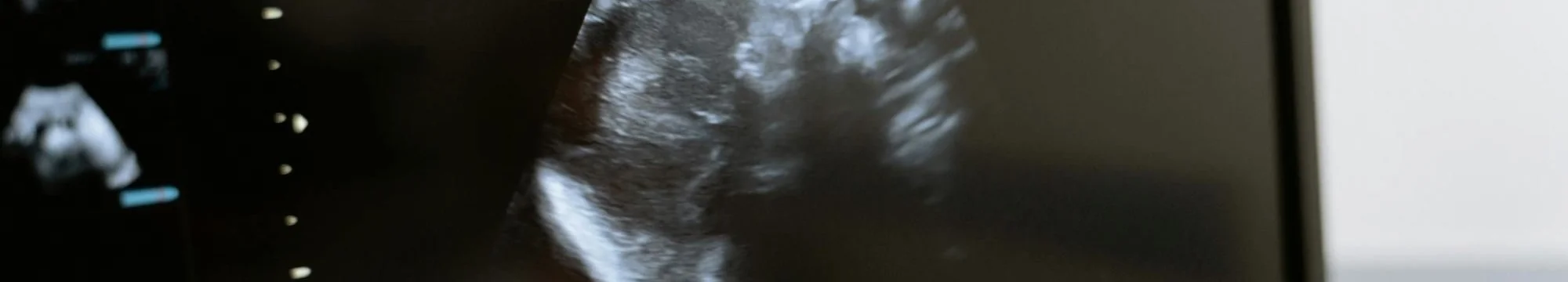 Dandy Walker Malformation Associated with Toxoplasmosis Infection in the Second Trimester: a Case Report