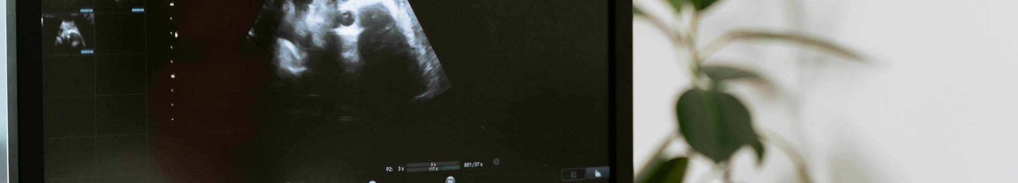 Significance of Timely Prenatal Care: A Case of Dandy-Walker Variant Diagnosed in the Third Trimester